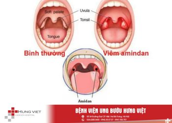 Dấu hiệu bệnh ở amidan cần thăm khám