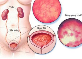 Dấu hiệu bệnh ở bàng quang bạn nên biết