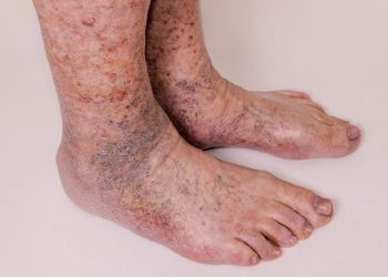 Dấu hiệu bệnh ở da chân gây khó chịu