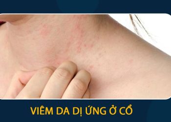 Dấu hiệu bệnh ở da cổ bạn nên biết