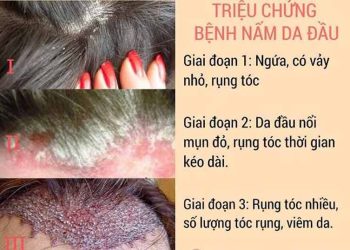 Dấu hiệu bệnh ở da đầu dễ nhận biết