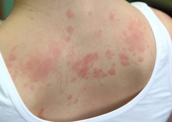 Dấu hiệu bệnh ở da lưng thường gặp