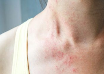 Dấu hiệu bệnh ở da ngực dễ bị bỏ qua