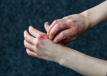 Dấu hiệu bệnh ở da tay bạn nên lưu ý