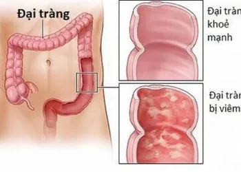 Dấu hiệu bệnh ở đại tràng cần thăm khám