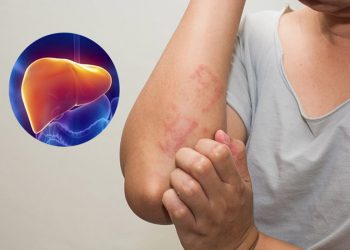 Dấu hiệu bệnh ở gan cần kiểm tra sớm