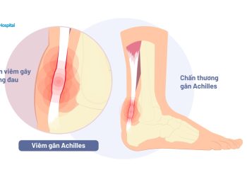 Dấu hiệu bệnh ở gân gây khó vận động