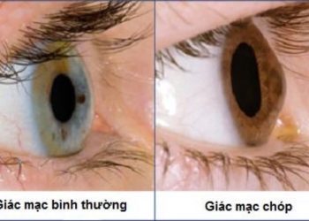 Dấu hiệu bệnh ở giác mạc ảnh hưởng thị lực