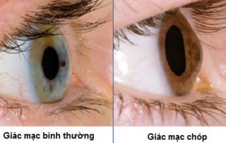 Dấu hiệu bệnh ở giác mạc ảnh hưởng thị lực