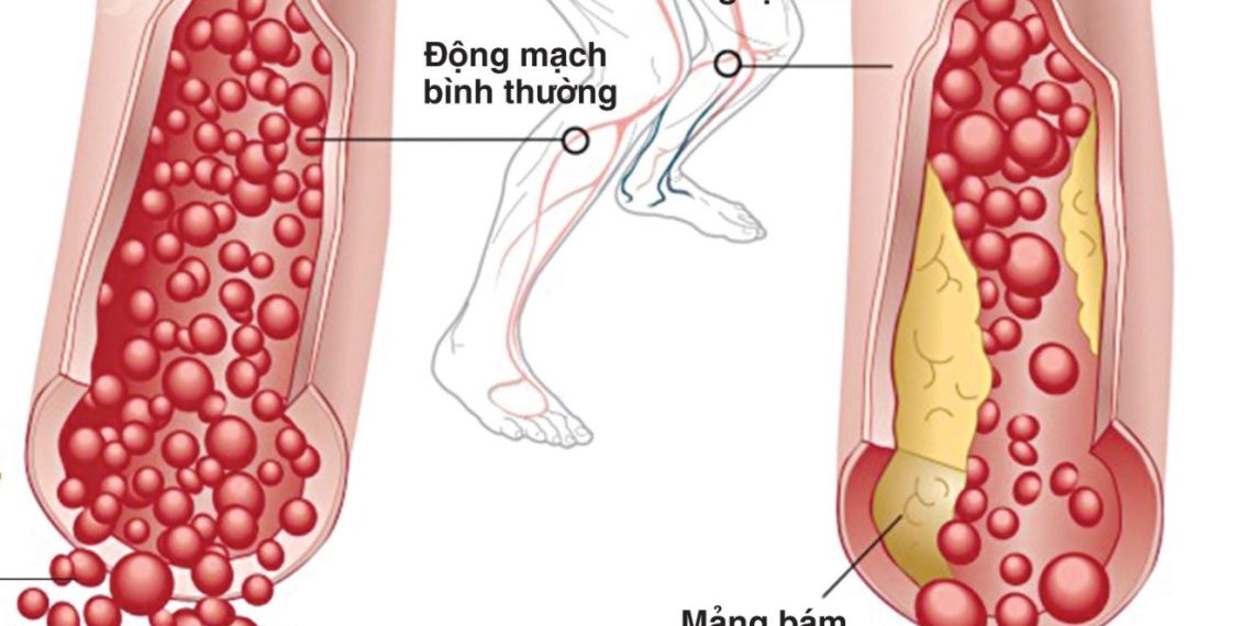 Dấu hiệu bệnh ở hệ tuần hoàn nguy hiểm nhất