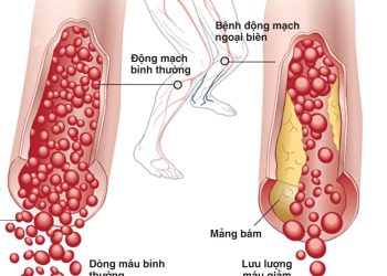 Dấu hiệu bệnh ở hệ tuần hoàn nguy hiểm nhất