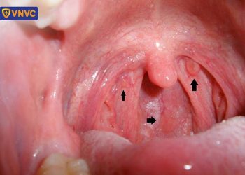 Dấu hiệu bệnh ở họng dưới nguy hiểm thế nào