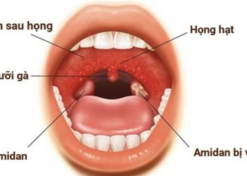 Dấu hiệu bệnh ở họng thường gặp