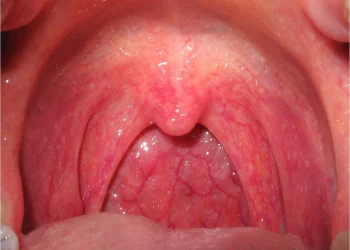 Dấu hiệu bệnh ở họng trên bạn không nên xem nhẹ