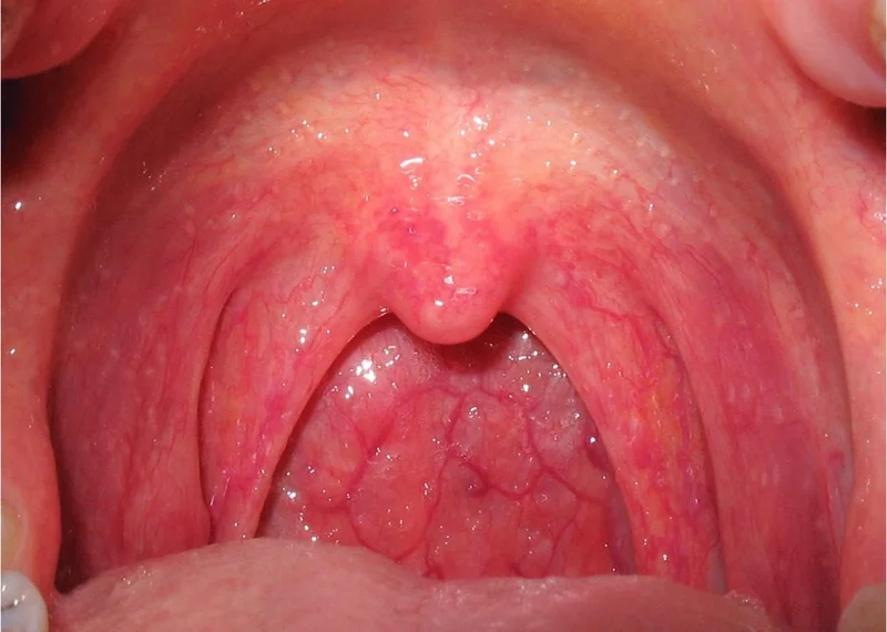 Dấu hiệu bệnh ở họng trên bạn không nên xem nhẹ