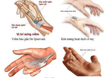 Dấu hiệu bệnh ở khớp cổ tay thường gặp