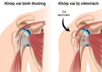 Dấu hiệu bệnh ở khớp vai gây khó chịu