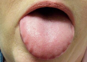 Dấu hiệu bệnh ở lưỡi cần kiểm tra