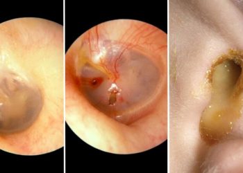 Dấu hiệu bệnh ở màng nhĩ bạn nên biết