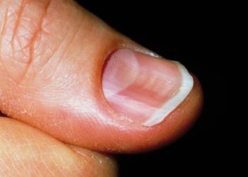 Dấu hiệu bệnh ở móng chân cần chú ý