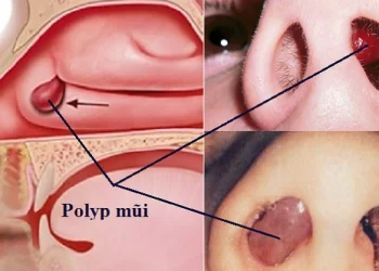 Dấu hiệu bệnh ở mũi ngoài dễ nhận biết