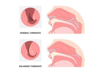 Dấu hiệu bệnh ở niêm mạc mũi gây khó chịu