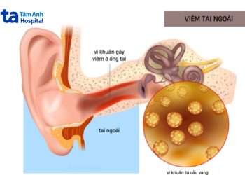 Dấu hiệu bệnh ở ống tai cần chú ý