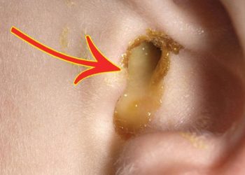 Dấu hiệu bệnh ở tai trong nguy hiểm ra sao