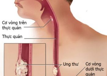 Dấu hiệu bệnh ở thực quản dễ bị bỏ qua