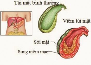 Dấu hiệu bệnh ở túi mật bạn không nên xem nhẹ