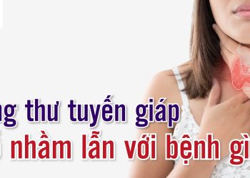 Dấu hiệu bệnh ở tuyến giáp dễ bị nhầm lẫn
