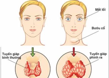 Dấu hiệu bệnh ở tuyến giáp trạng nguy hiểm ra sao