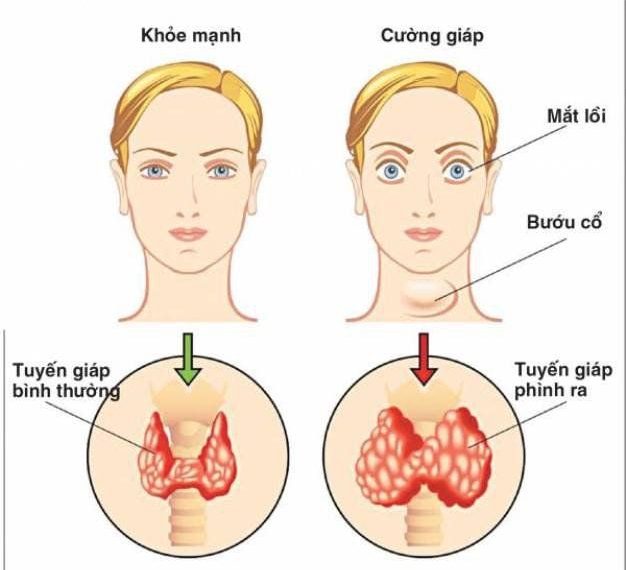 Dấu hiệu bệnh ở tuyến giáp trạng nguy hiểm ra sao