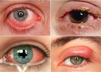 Dấu hiệu bệnh ở tuyến lệ gây khô mắt