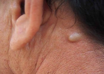 Dấu hiệu bệnh ở tuyến mồ hôi thường gặp