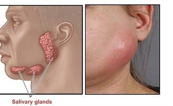 Dấu hiệu bệnh ở tuyến nước bọt thường gặp