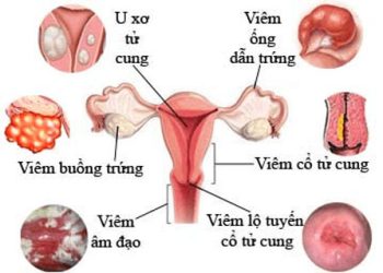 Dấu hiệu bệnh ở tuyến sinh dục ở phụ nữ