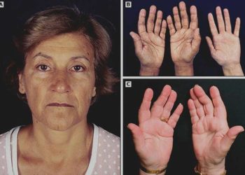 Dấu hiệu bệnh ở tuyến thượng thận cần biết