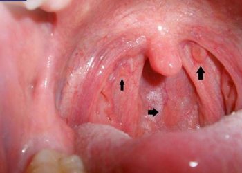 Dấu hiệu bệnh ở vòm họng bạn nên lưu ý