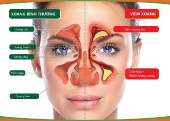 Dấu hiệu bệnh ở xoang mũi thường gặp