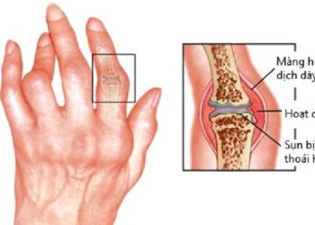 Dấu hiệu bệnh ở xương bàn tay dễ nhận thấy