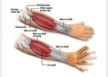 Dấu hiệu bệnh ở xương cánh tay gây đau nhức