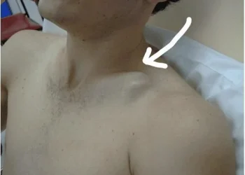 Dấu hiệu bệnh ở xương đòn cần kiểm tra