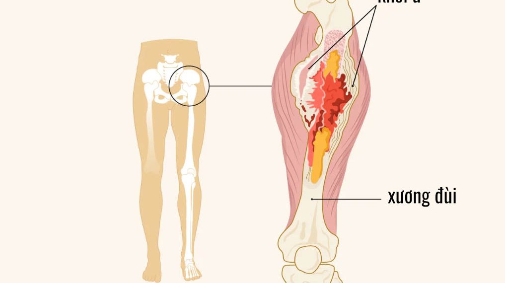 Dấu hiệu bệnh ở xương đùi bạn nên lưu ý