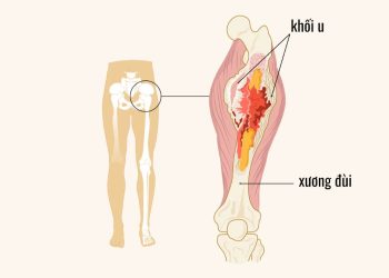 Dấu hiệu bệnh ở xương đùi bạn nên lưu ý