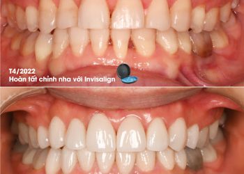 Mẹo giữ răng khỏe cho người mới làm răng sứ