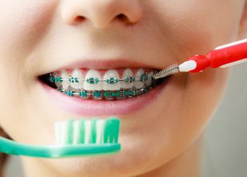Mẹo giữ răng khỏe cho người mới niềng răng
